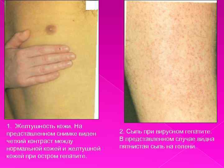 1. Желтушность кожи. На представленном снимке виден четкий контраст между нормальной кожей и желтушной