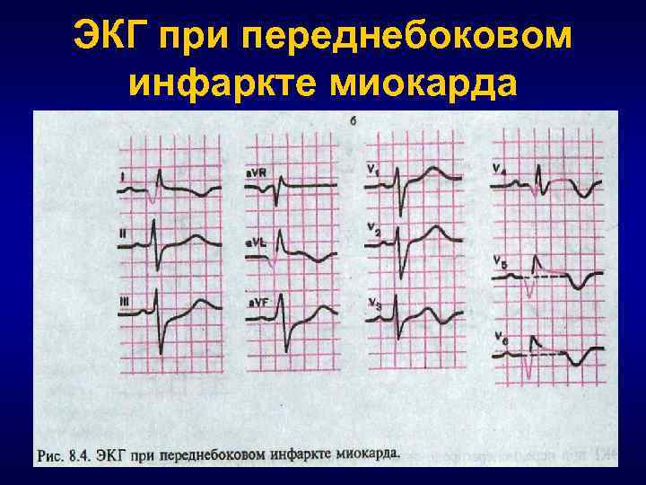 Как выглядит кардиограмма при инфаркте миокарда фото с расшифровкой