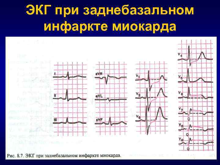 ЭКГ при заднебазальном инфаркте миокарда 