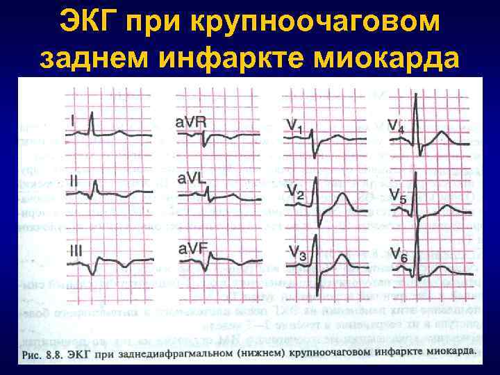 Конкордантный подъем st. Острый коронарный синдром с подъемом St на ЭКГ. Segment St ECG infarctus. Подъем сегмента St на ЭКГ.