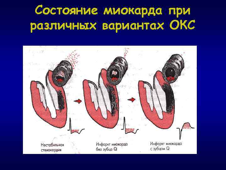 Состояние миокарда при различных вариантах ОКС 