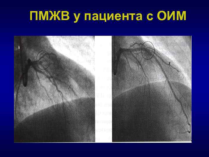 ПМЖВ у пациента с ОИМ 