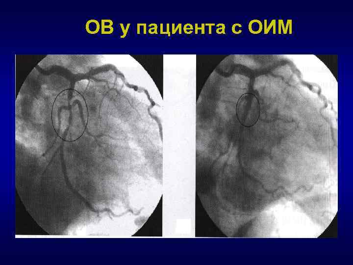 ОВ у пациента с ОИМ 