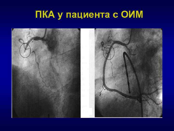 ПКА у пациента с ОИМ 