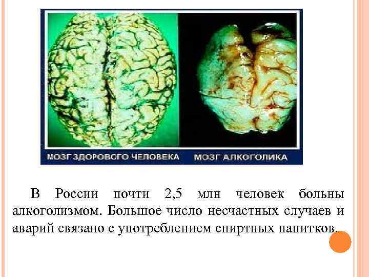 В России почти 2, 5 млн человек больны алкоголизмом. Большое число несчастных случаев и