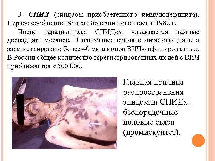 3. СПИД (синдром приобретенного иммунодефицита). Первое сообщение об этой болезни появилось в 1982 г.