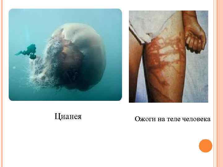 Цианея Ожоги на теле человека 