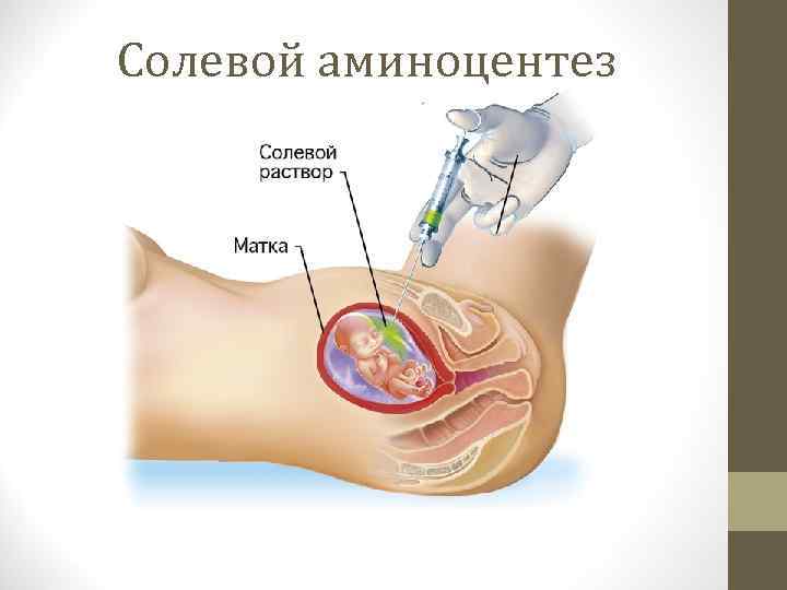 Солевой аминоцентез 