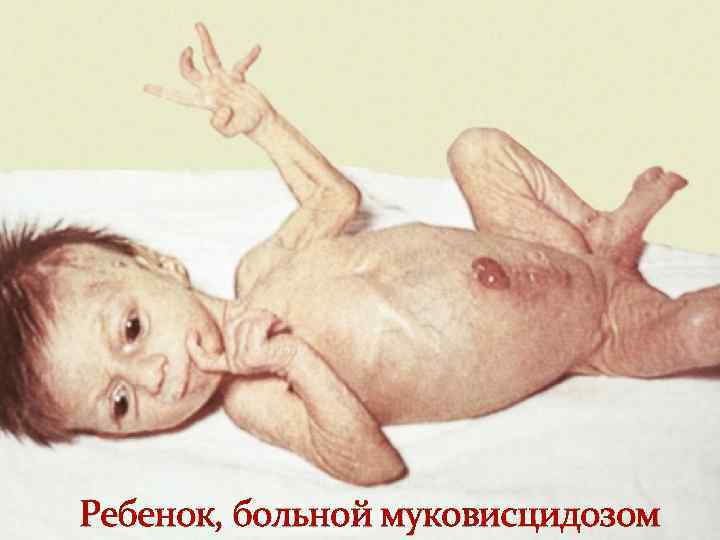 Ребенок, больной муковисцидозом 