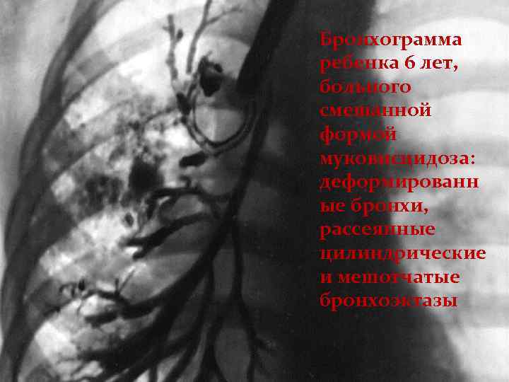Бронхограмма ребенка 6 лет, больного смешанной формой муковисцидоза: деформированн ые бронхи, рассеянные цилиндрические и