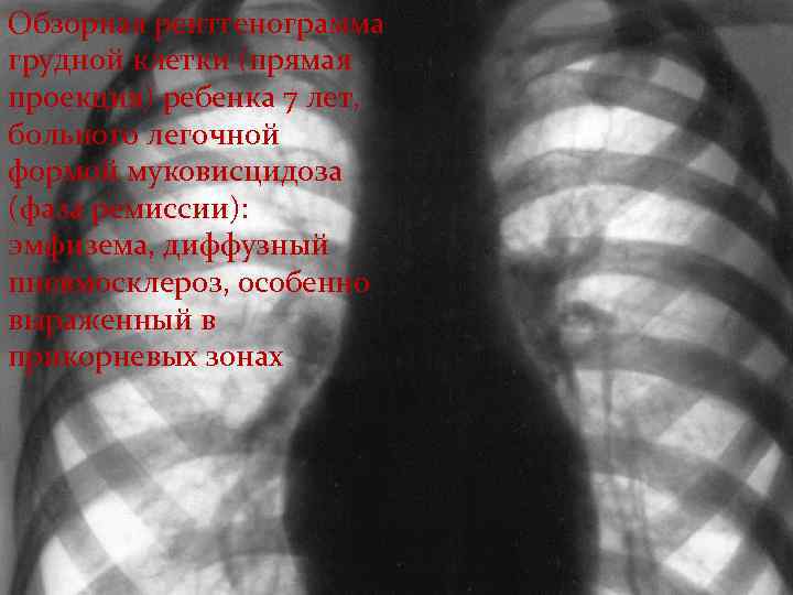 Обзорная рентгенограмма грудной клетки (прямая проекция) ребенка 7 лет, больного легочной формой муковисцидоза (фаза