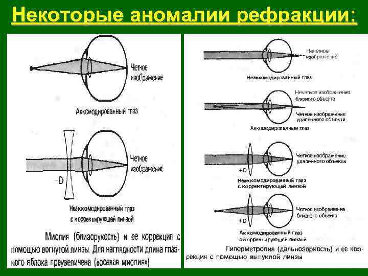 Некоторые аномалии рефракции: 