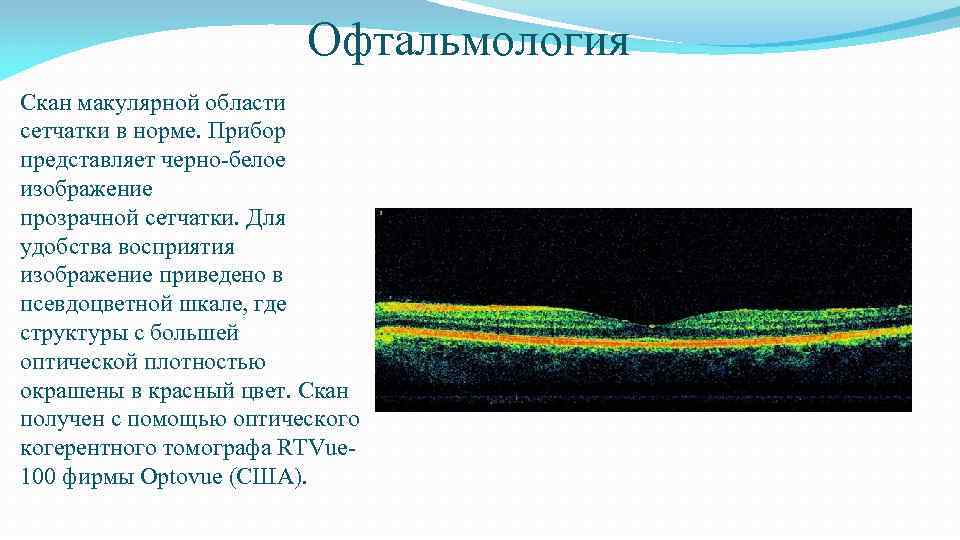 Офтальмология Скан макулярной области сетчатки в норме. Прибор представляет черно-белое изображение прозрачной сетчатки. Для