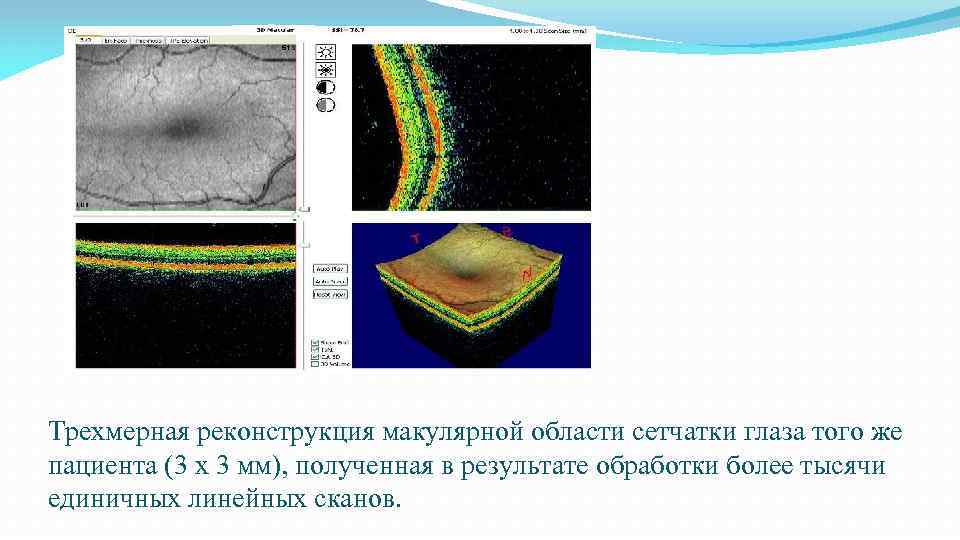 Трехмерная реконструкция макулярной области сетчатки глаза того же пациента (3 х 3 мм), полученная