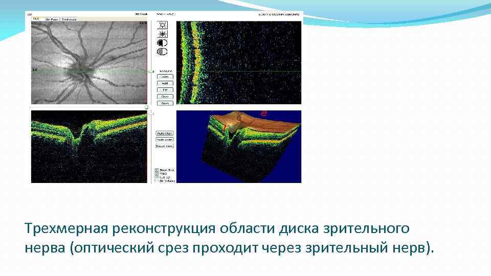 Трехмерная реконструкция области диска зрительного нерва (оптический срез проходит через зрительный нерв). 