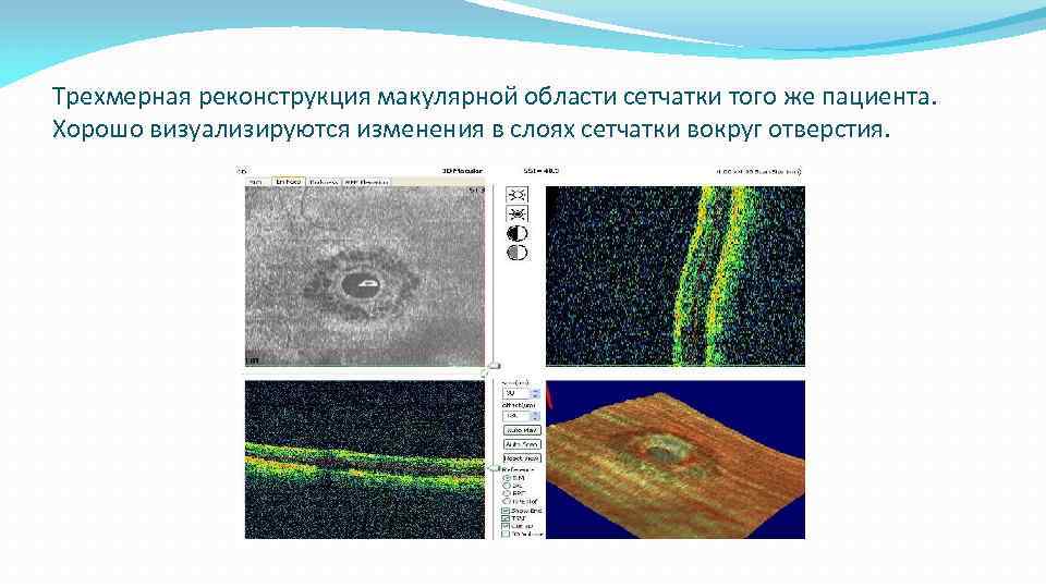 Трехмерная реконструкция макулярной области сетчатки того же пациента. Хорошо визуализируются изменения в слоях сетчатки