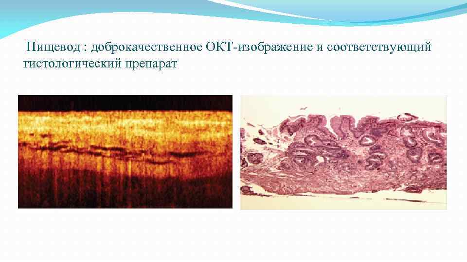  Пищевод : доброкачественное ОКТ-изображение и соответствующий гистологический препарат 