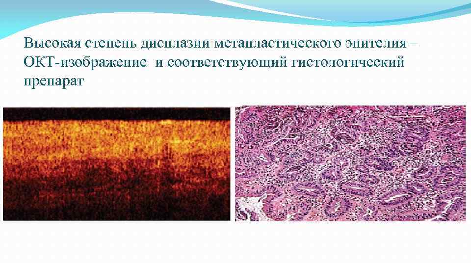 Высокая степень дисплазии метапластического эпителия – ОКТ-изображение и соответствующий гистологический препарат 