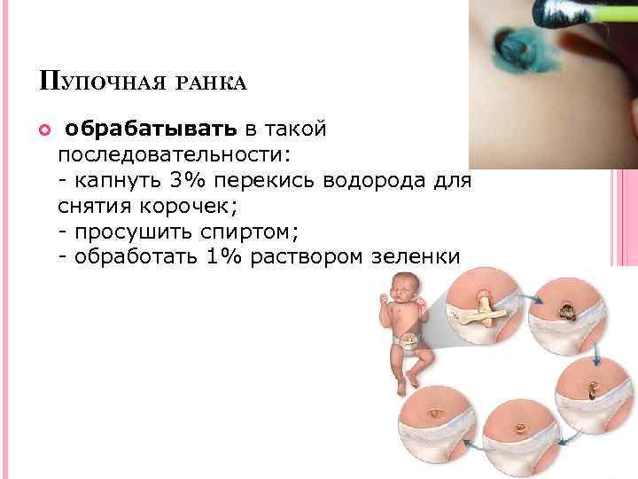 ПУПОЧНАЯ РАНКА обрабатывать в такой последовательности: - капнуть 3% перекись водорода для снятия корочек;