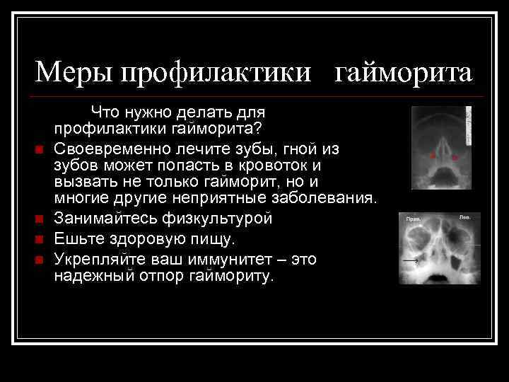 Меры профилактики гайморита n n Что нужно делать для профилактики гайморита? Своевременно лечите зубы,