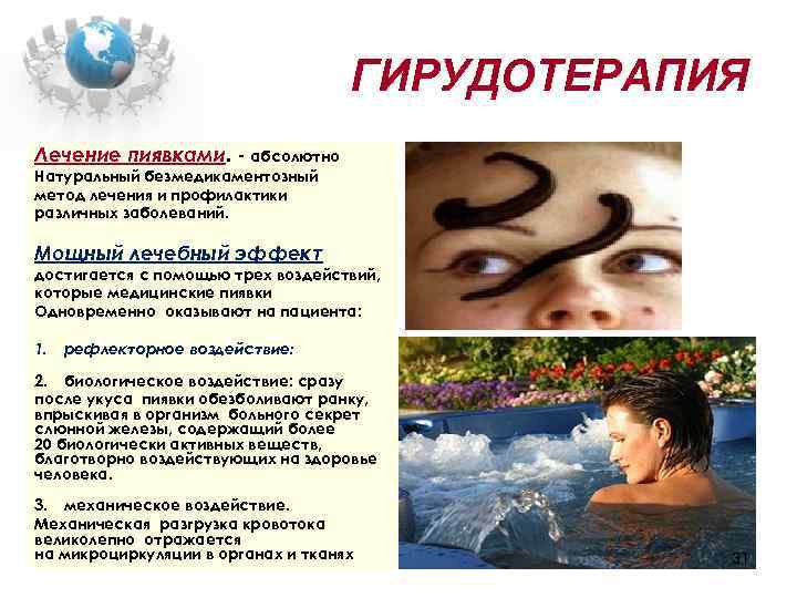 ГИРУДОТЕРАПИЯ Лечение пиявками. - абсолютно Натуральный безмедикаментозный метод лечения и профилактики различных заболеваний. Мощный