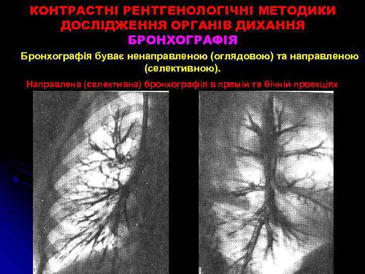 КОНТРАСТНІ РЕНТГЕНОЛОГІЧНІ МЕТОДИКИ ДОСЛІДЖЕННЯ ОРГАНІВ ДИХАННЯ БРОНХОГРАФІЯ Бронхографія буває ненаправленою (оглядовою) та направленою (селективною).