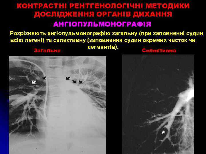 КОНТРАСТНІ РЕНТГЕНОЛОГІЧНІ МЕТОДИКИ ДОСЛІДЖЕННЯ ОРГАНІВ ДИХАННЯ АНГІОПУЛЬМОНОГРАФІЯ Розрізняють ангіопульмонографію загальну (при заповненні судин всієї