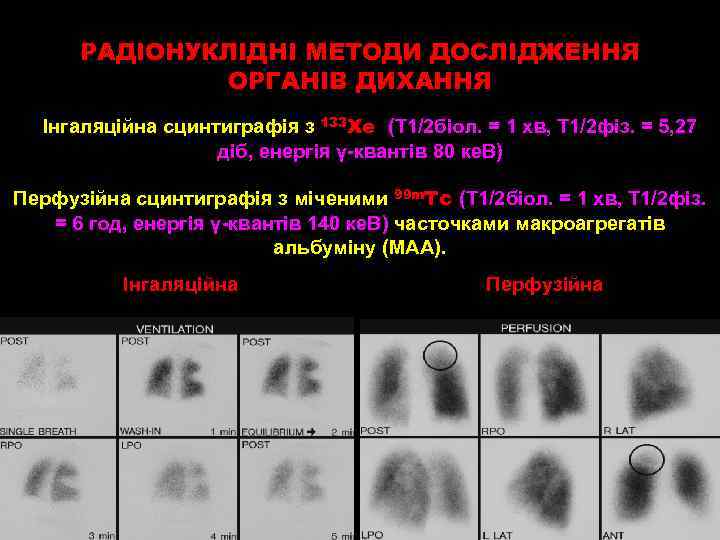 РАДІОНУКЛІДНІ МЕТОДИ ДОСЛІДЖЕННЯ ОРГАНІВ ДИХАННЯ Інгаляційна сцинтиграфія з 133 Xe (Т 1/2 біол. =
