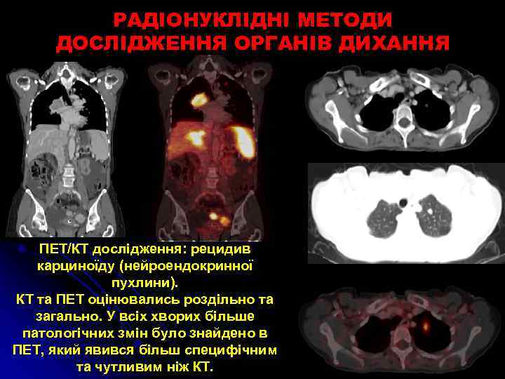 РАДІОНУКЛІДНІ МЕТОДИ ДОСЛІДЖЕННЯ ОРГАНІВ ДИХАННЯ ПЕТ/КT дослідження: рецидив карциноїду (нейроендокринної пухлини). КТ та ПЕТ