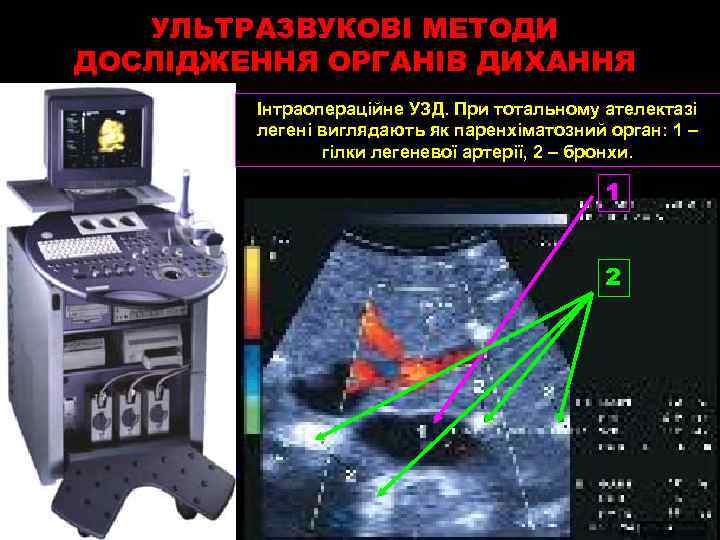 УЛЬТРАЗВУКОВІ МЕТОДИ ДОСЛІДЖЕННЯ ОРГАНІВ ДИХАННЯ Інтраопераційне УЗД. При тотальному ателектазі легені виглядають як паренхіматозний
