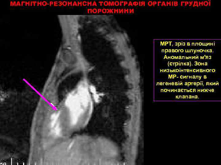 МАГНІТНО-РЕЗОНАНСНА ТОМОГРАФІЯ ОРГАНІВ ГРУДНОЇ ПОРОЖНИНИ МРТ, зріз в площині правого шлуночка. Аномальний м'яз (стрілка).