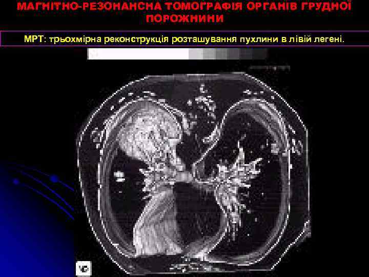 МАГНІТНО-РЕЗОНАНСНА ТОМОГРАФІЯ ОРГАНІВ ГРУДНОЇ ПОРОЖНИНИ МРТ: трьохмірна реконструкція розташування пухлини в лівій легені. 