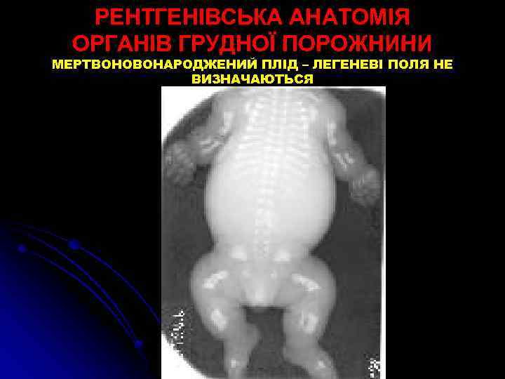 РЕНТГЕНІВСЬКА АНАТОМІЯ ОРГАНІВ ГРУДНОЇ ПОРОЖНИНИ МЕРТВОНОВОНАРОДЖЕНИЙ ПЛІД – ЛЕГЕНЕВІ ПОЛЯ НЕ ВИЗНАЧАЮТЬСЯ 