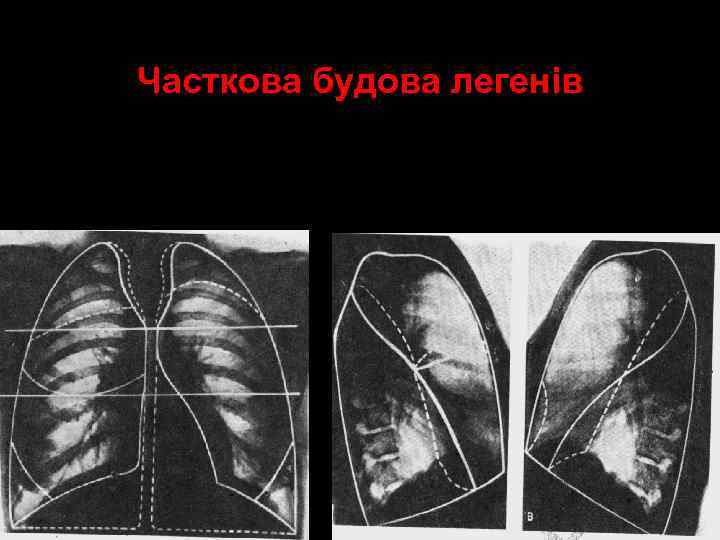 Часткова будова легенів 