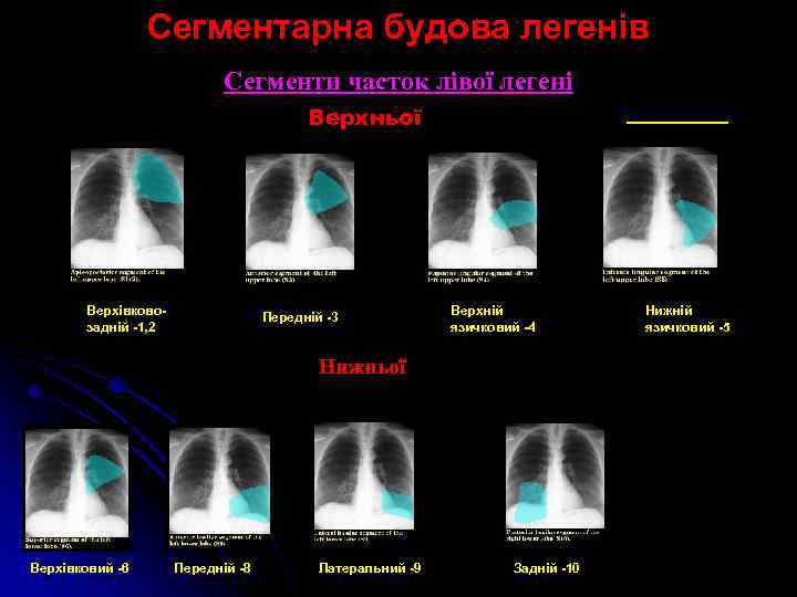 Сегментарна будова легенів Сегменти часток лівої легені Верхньої Верхівковозадній -1, 2 Передній -3 Верхній