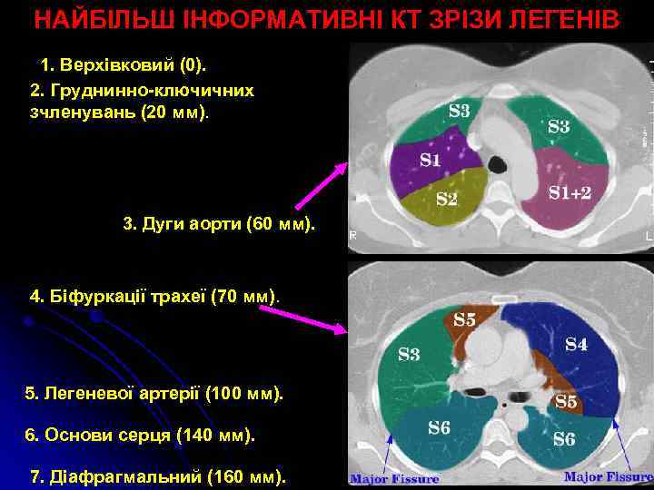 НАЙБІЛЬШ ІНФОРМАТИВНІ КТ ЗРІЗИ ЛЕГЕНІВ 1. Верхівковий (0). 2. Груднинно-ключичних зчленувань (20 мм). 3.
