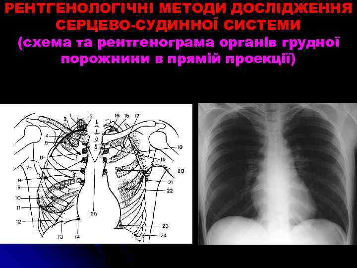 РЕНТГЕНОЛОГІЧНІ МЕТОДИ ДОСЛІДЖЕННЯ СЕРЦЕВО-СУДИННОЇ СИСТЕМИ (схема та рентгенограма органів грудної порожнини в прямій проекції)
