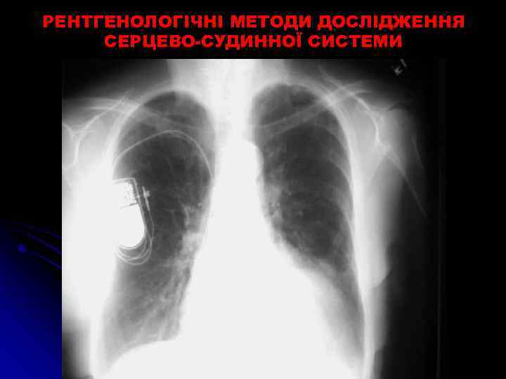РЕНТГЕНОЛОГІЧНІ МЕТОДИ ДОСЛІДЖЕННЯ СЕРЦЕВО-СУДИННОЇ СИСТЕМИ 