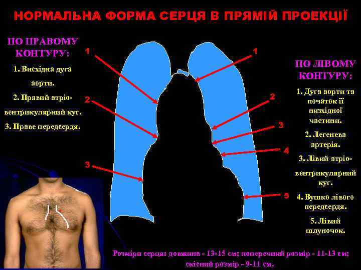 НОРМАЛЬНА ФОРМА СЕРЦЯ В ПРЯМІЙ ПРОЕКЦІЇ ПО ПРАВОМУ КОНТУРУ: 1 1 ПО ЛІВОМУ КОНТУРУ: