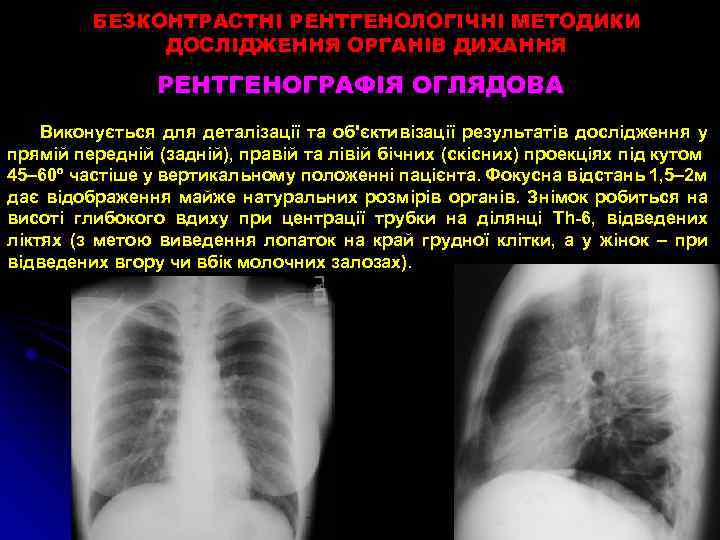 БЕЗКОНТРАСТНІ РЕНТГЕНОЛОГІЧНІ МЕТОДИКИ ДОСЛІДЖЕННЯ ОРГАНІВ ДИХАННЯ РЕНТГЕНОГРАФІЯ ОГЛЯДОВА Виконується для деталізації та об'єктивізації результатів