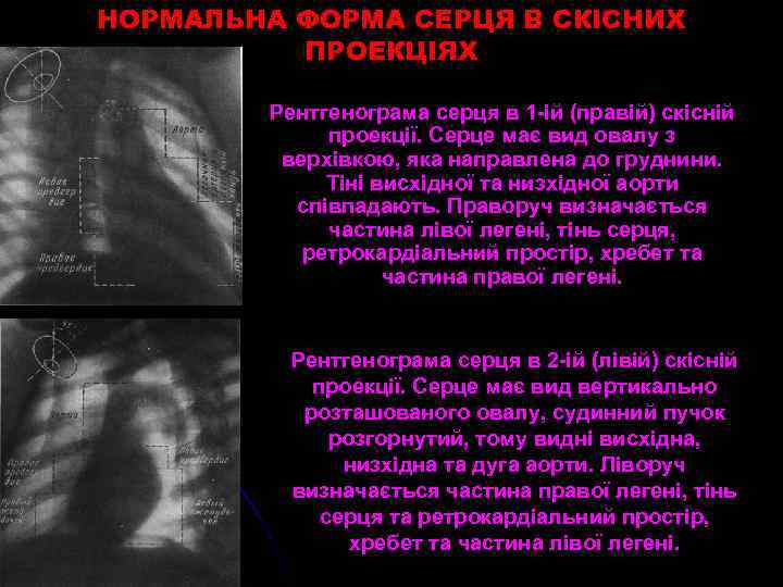 НОРМАЛЬНА ФОРМА СЕРЦЯ В СКІСНИХ ПРОЕКЦІЯХ Рентгенограма серця в 1 -ій (правій) скісній проекції.