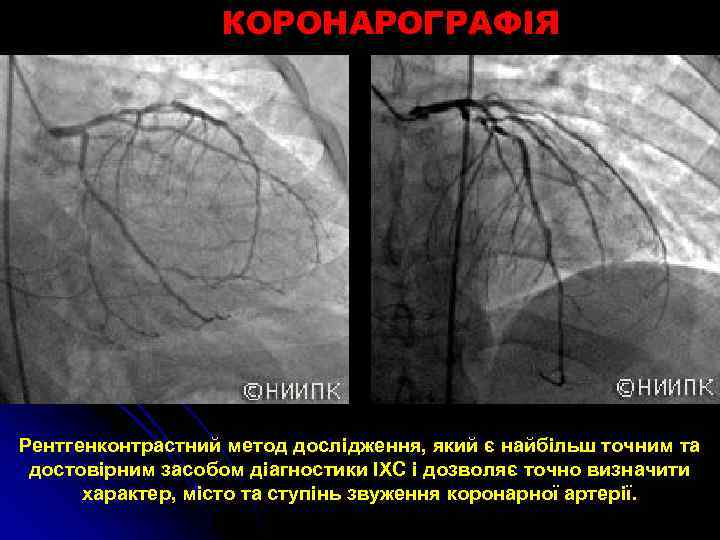 КОРОНАРОГРАФІЯ Рентгенконтрастний метод дослідження, який є найбільш точним та достовірним засобом діагностики ІХС і