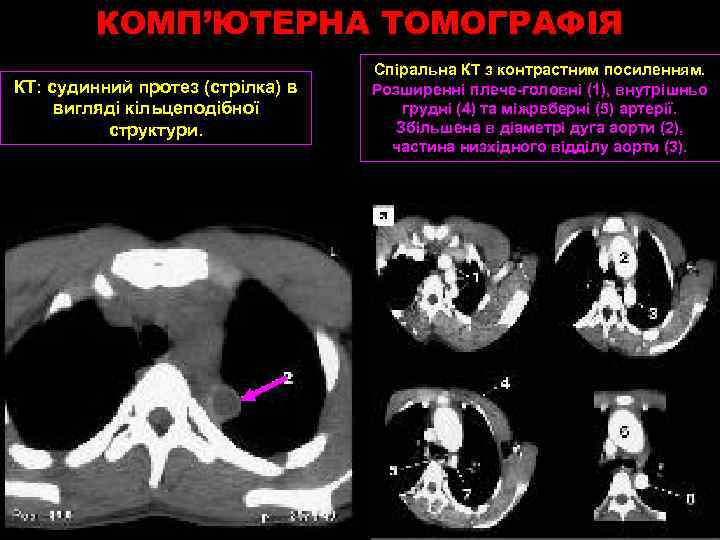 КОМП’ЮТЕРНА ТОМОГРАФІЯ КТ: судинний протез (стрілка) в вигляді кільцеподібної структури. Спіральна КТ з контрастним