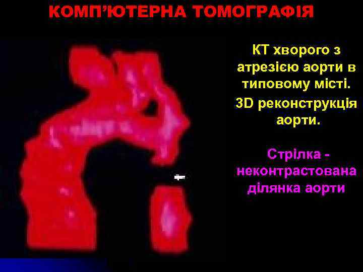 КОМП’ЮТЕРНА ТОМОГРАФІЯ КТ хворого з атрезією аорти в типовому місті. 3 D реконструкція аорти.