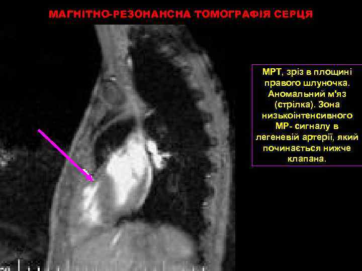МАГНІТНО-РЕЗОНАНСНА ТОМОГРАФІЯ СЕРЦЯ МРТ, зріз в площині правого шлуночка. Аномальний м'яз (стрілка). Зона низькоінтенсивного