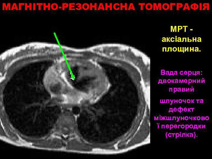 МАГНІТНО-РЕЗОНАНСНА ТОМОГРАФІЯ МРТ аксіальна площина. Вада серця: двокамерний правий шлуночок та дефект міжшлуночково ї