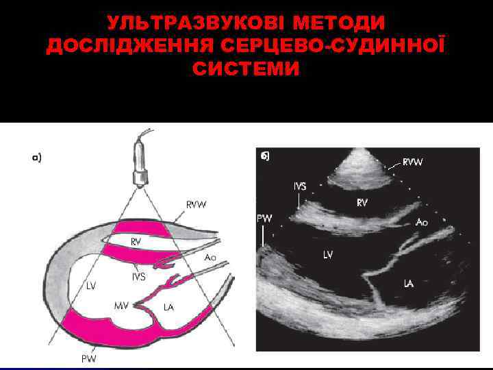 УЛЬТРАЗВУКОВІ МЕТОДИ ДОСЛІДЖЕННЯ СЕРЦЕВО-СУДИННОЇ СИСТЕМИ 