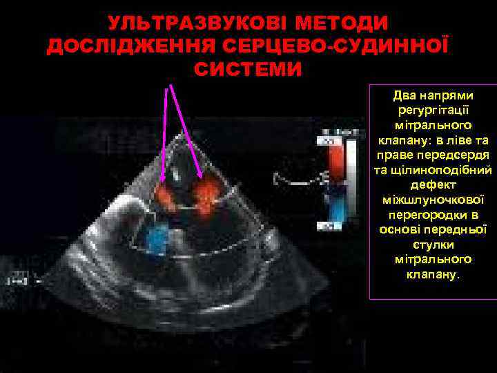 УЛЬТРАЗВУКОВІ МЕТОДИ ДОСЛІДЖЕННЯ СЕРЦЕВО-СУДИННОЇ СИСТЕМИ Два напрями регургітації мітрального клапану: в ліве та праве