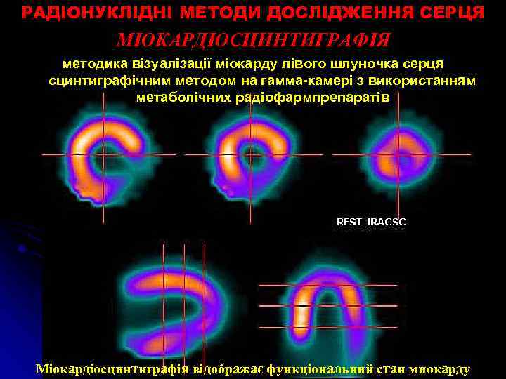 РАДІОНУКЛІДНІ МЕТОДИ ДОСЛІДЖЕННЯ СЕРЦЯ МІОКАРДІОСЦИНТИГРАФІЯ методика візуалізації міокарду лівого шлуночка серця сцинтиграфічним методом на