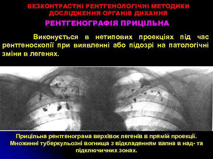 БЕЗКОНТРАСТНІ РЕНТГЕНОЛОГІЧНІ МЕТОДИКИ ДОСЛІДЖЕННЯ ОРГАНІВ ДИХАННЯ РЕНТГЕНОГРАФІЯ ПРИЦІЛЬНА Виконується в нетипових проекціях під час
